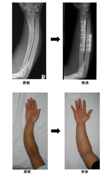 上肢骨折変形治癒(前腕骨折変形治癒や内反肘変形など)