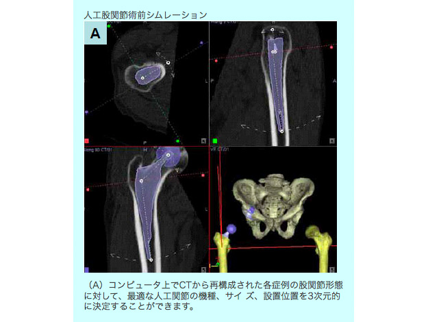 治療の決定(Computer術前計画)