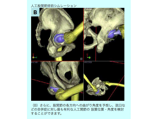 治療の決定(Computer術前計画)