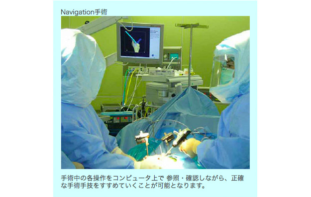 治療技術(Navigation手術)