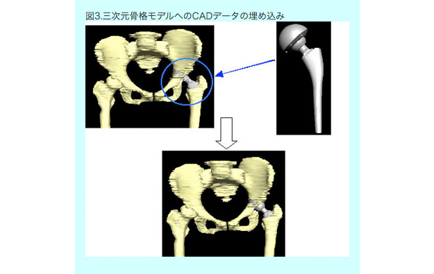 2.CADデータによる人工股関節部分のモデルの精度向上