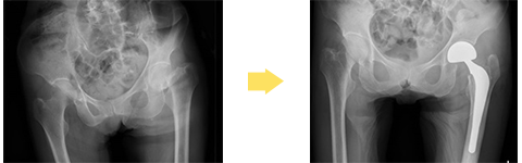 大腿骨頚部骨折に対し、人工骨頭置換術