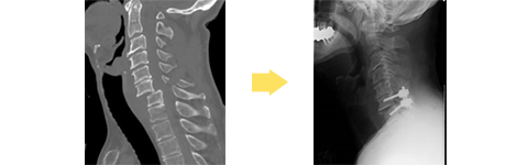頚椎脱臼骨折に対し、ハローベスト装着後、頚椎後方固定術