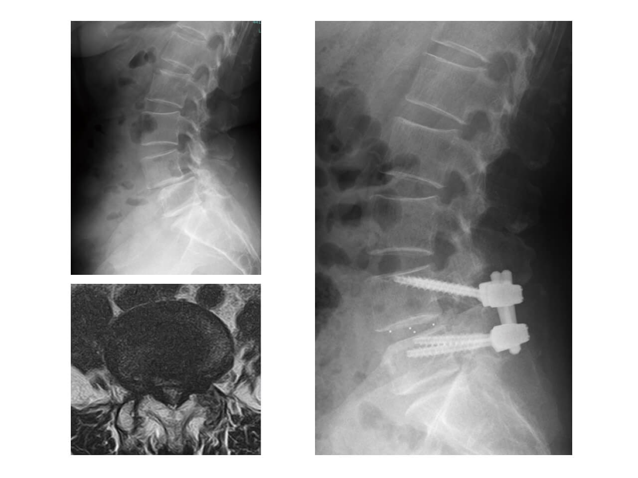 腰部脊柱管狭窄症・すべり症